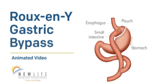 Roux-en-Y Gastric Bypass (RYGB) Surgery in India