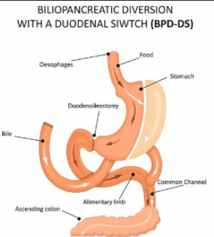 Biliopancreatic Diversion with Duodenal Switch (BPD/DS) Surgery in India