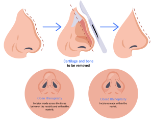 Rhinoplasty in India