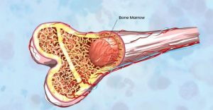 Understanding When a Bone Marrow Transplant is Necessary