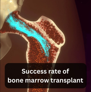 Evaluating the Success Rates and Outcomes of Bone Marrow Transplants