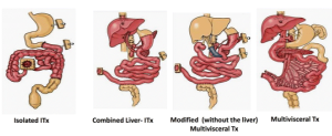 Complications After Intestine Transplant: How to Identify and Manage Risks