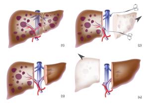 liver transplant