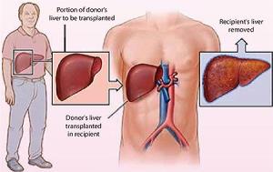 liver Transplant