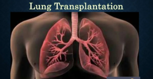 Lung Transplant in India