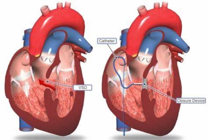 Minimally Invasive Approaches in VSD Surgery