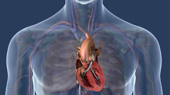 LVAD as a Bridge to Heart Transplant for Congenital Heart Defects