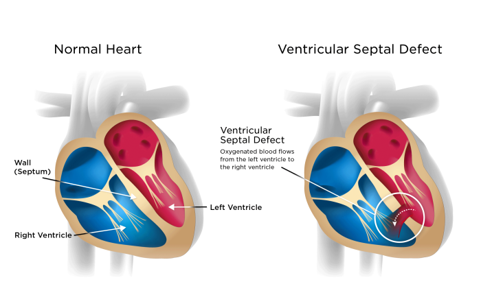 Overview of the Surgical Process for VSD Repair