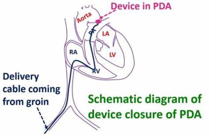 An Overview of PDA Device Closure