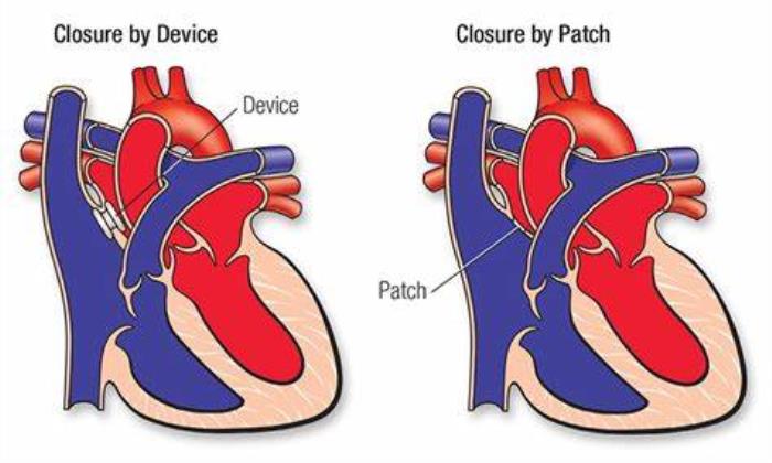 Traditional vs. Modern Approaches to ASD Closure