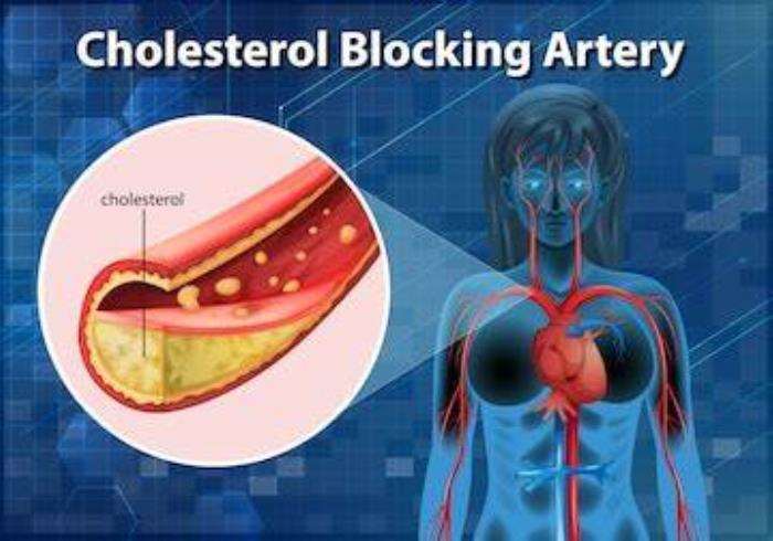 How High Cholesterol Contributes to Artery Blockages