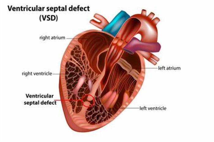 Potential for Right or Left Heart Failure After VSD Surgery