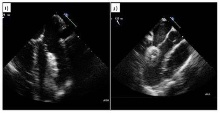 The Role of Imaging in Planning and Performing ASD Closure