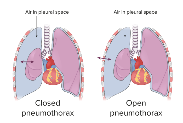 Pneumothorax Risk of Collapsed Lung During Surgery