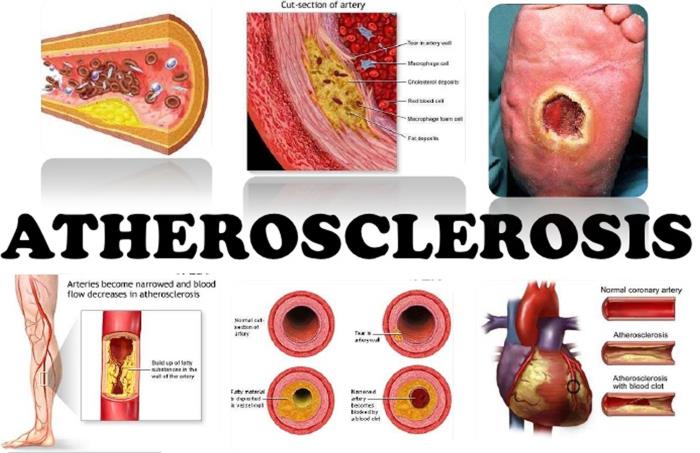 Atherosclerosis