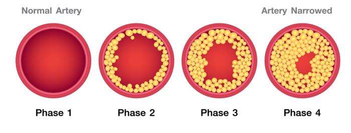 The Role of High Cholesterol in Aneurysm Formation