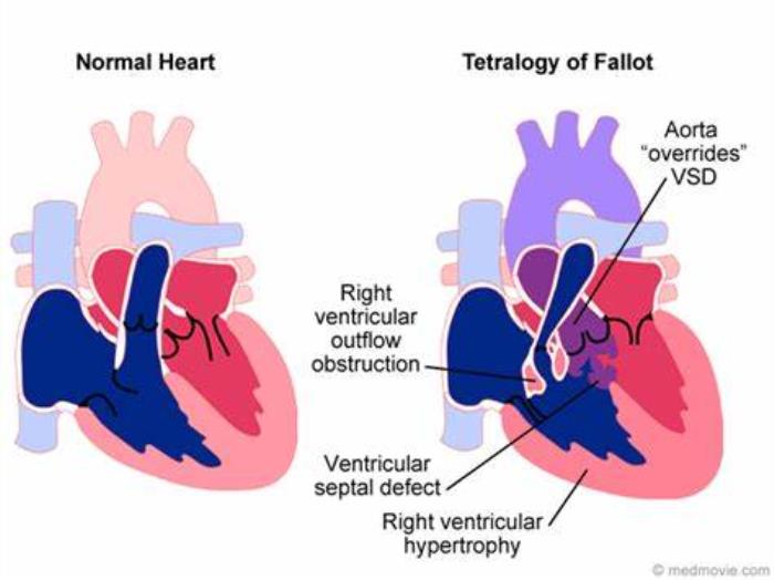 Traditional Imaging Methods for Tetralogy of Fallot Diagnosis