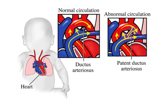 Common Symptoms of PDA in Children and Infants