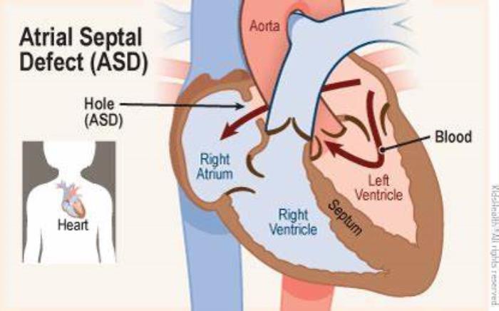 Monitoring Heart Function After ASD Closure Surgery