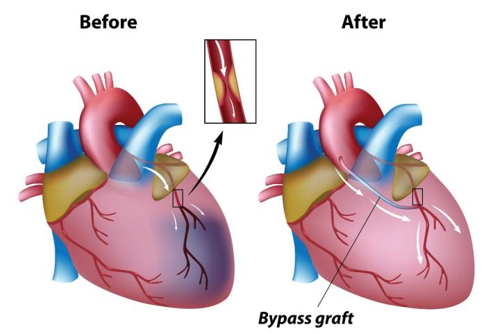 Common Risks Associated with Heart Bypass Surgery