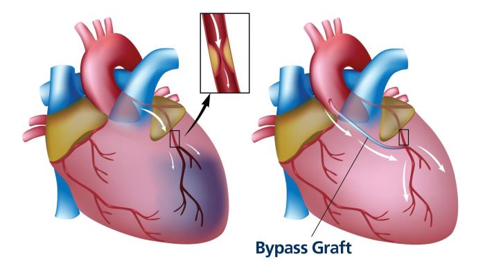 The Mechanism of Action: How Bypass Surgery Works