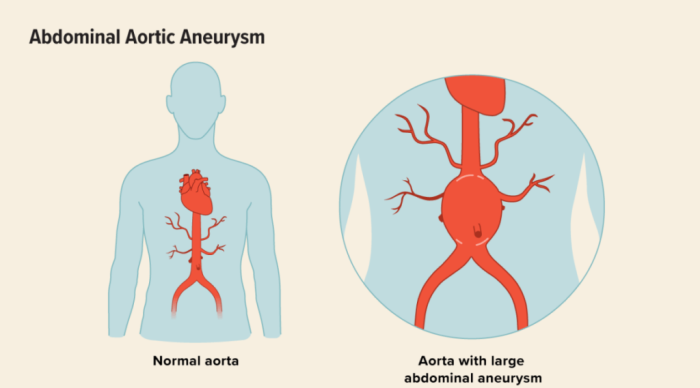 Common Symptoms of Abdominal Aortic Aneurysm