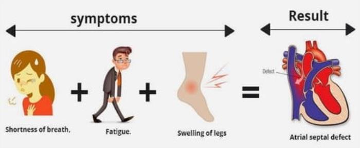 Common Symptoms of ASD During Physical Activity