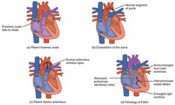 How Congenital Heart Defects Affect Heart Function