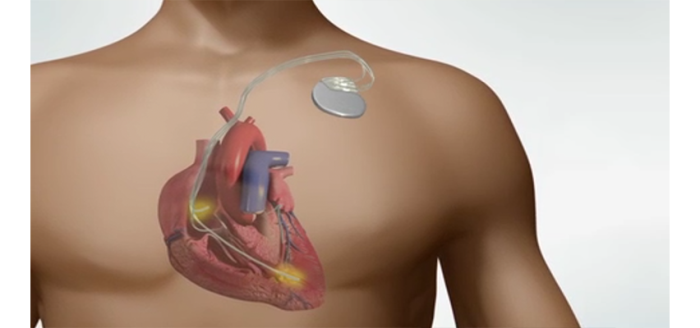 Overview of Traditional AICD Implantation Techniques