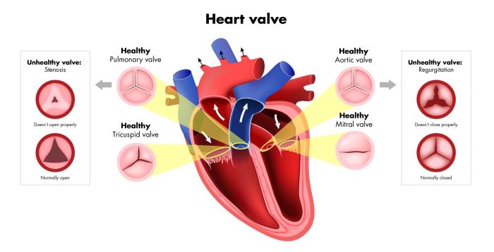 Common Symptoms Associated with Heart Valve Problems