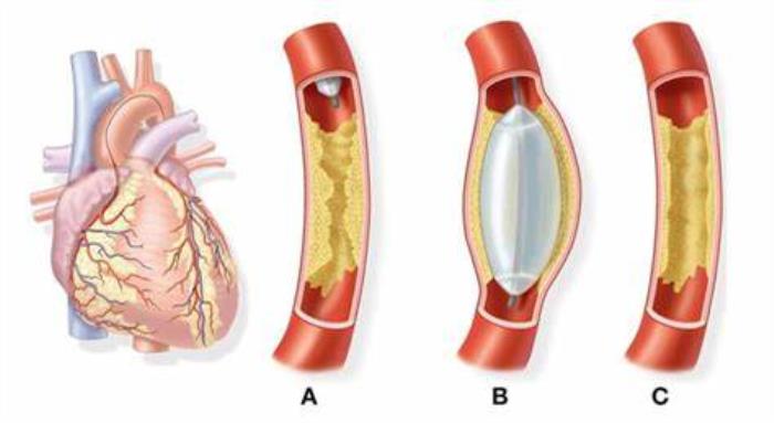 Imaging is Essential in Angioplasty Procedures