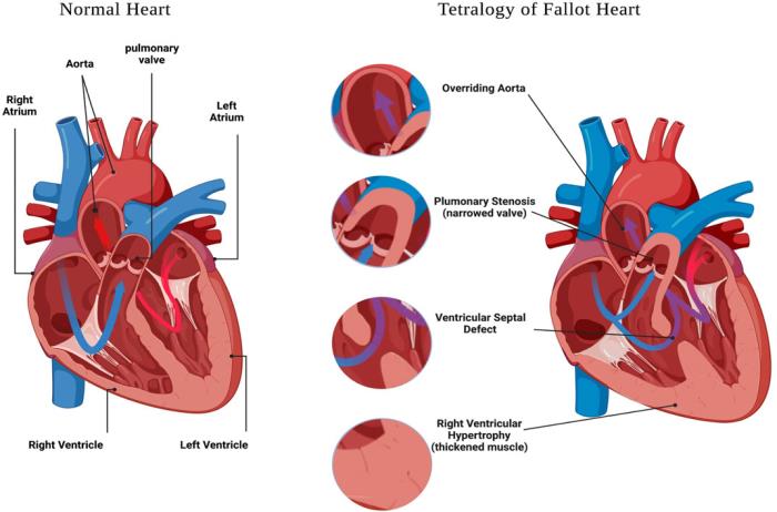 How Right Ventricular Function Impacts Overall Cardiac Health in Tetralogy of Fallot