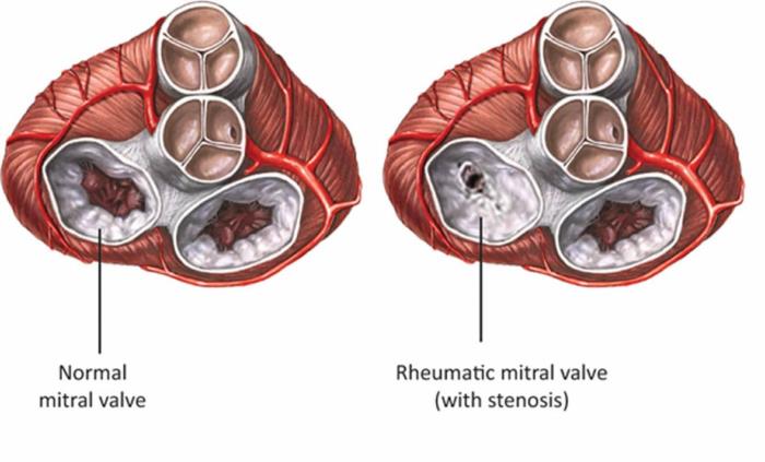 The Psychological Impact of Heart Valve Disease