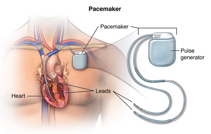 The Role of External Pacemakers in Temporary Cardiac Support