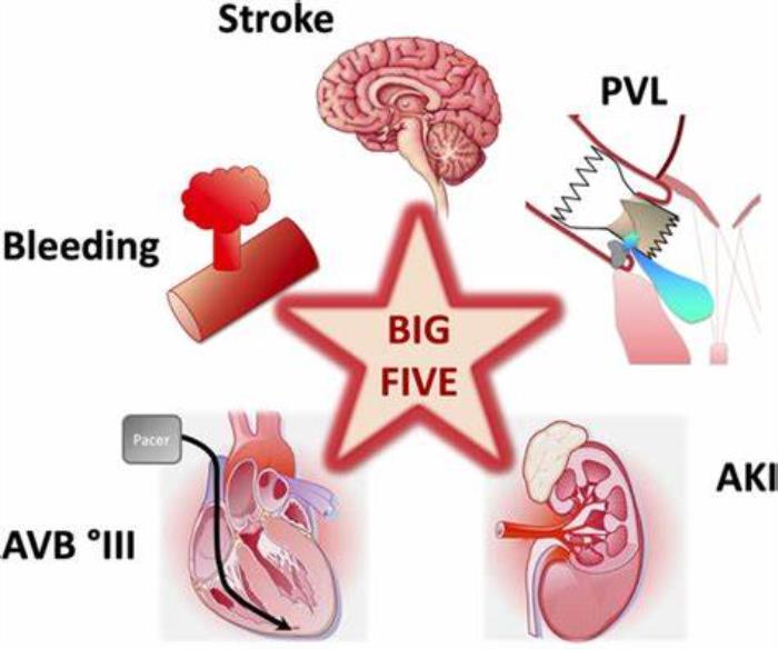 Monitoring for Complications and Warning Signs After TAVR