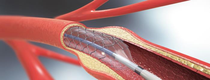 How Age Influences the Risk of Restenosis After Angioplasty