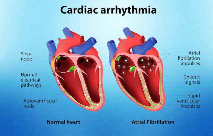 Improved Outcomes for Patients with Arrhythmias