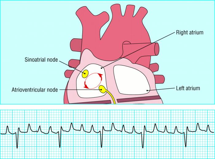 Arrhythmias and Other Electrical Complications Caused by ASD