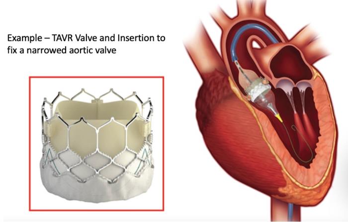 Lower Incidence of Complications with TAVR