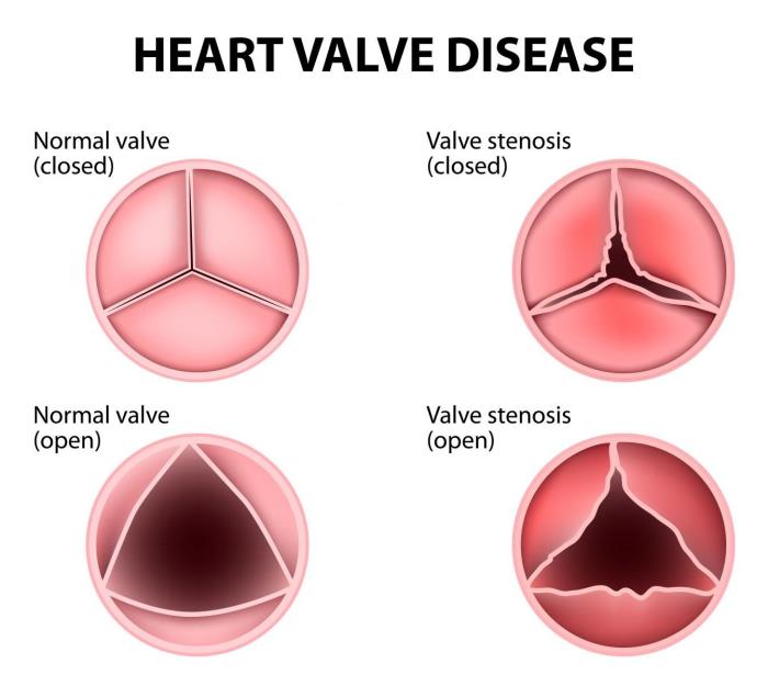 How Mitral Valve Issues Can Affect Overall Heart Function