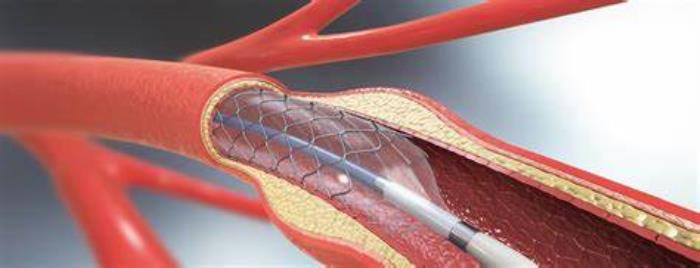 Rare but Serious Complications During Angioplasty