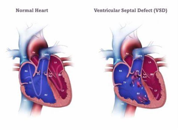 Recognizing Symptoms of VSD in Teenagers and Adults