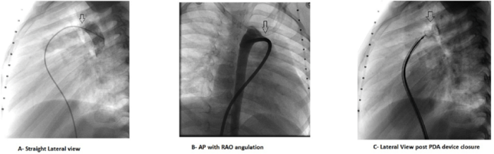 How Catheterization Plays a Role in PDA Treatment