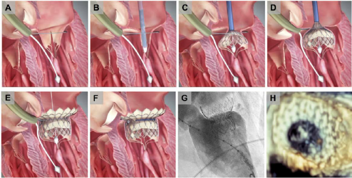 Transcatheter Mitral Valve Repair (TMVR)