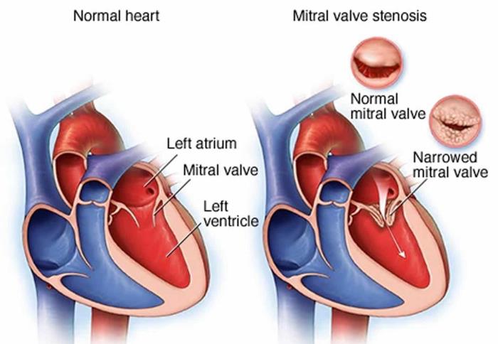 The Severity of Mitral Valve Disease Prior to Surgery