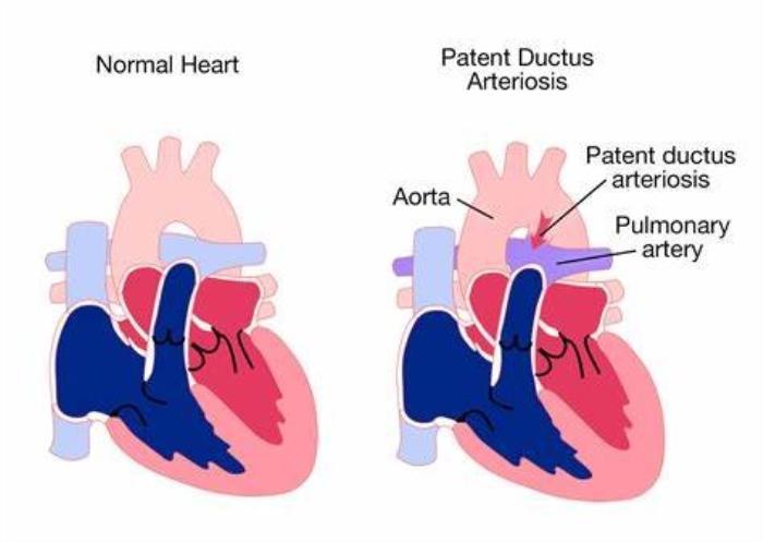 Immediate Risks of Untreated PDA