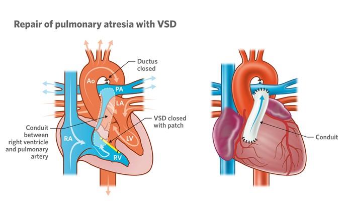 How Does VSD Contribute to Pulmonary Hypertension