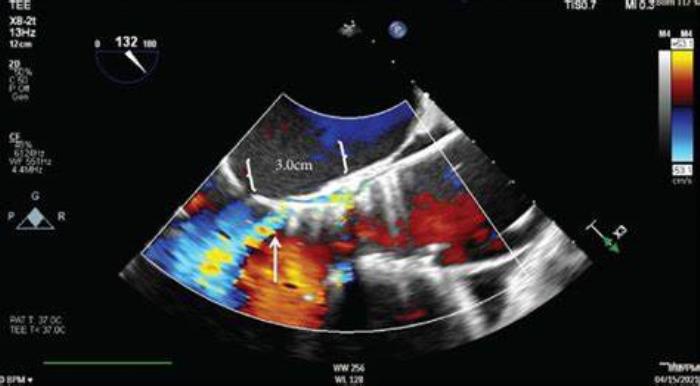 The Role of Echocardiograms in Detecting Valve Malfunction After TAVR