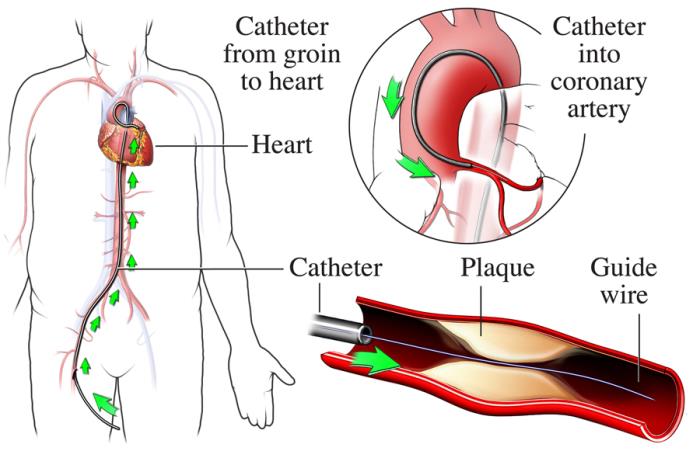 Potential Risks and Complications of Catheterization