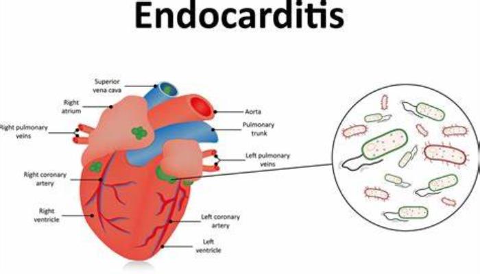 Increased Risk of Infections like Endocarditis